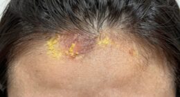 identifying scalp buildup issues
