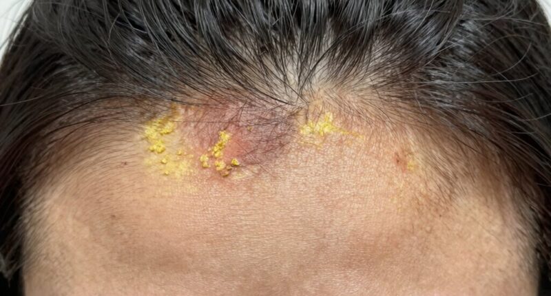 identifying scalp buildup issues